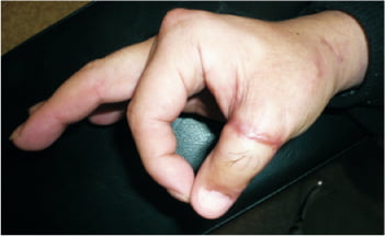 切断指あとの欠損(親指など)