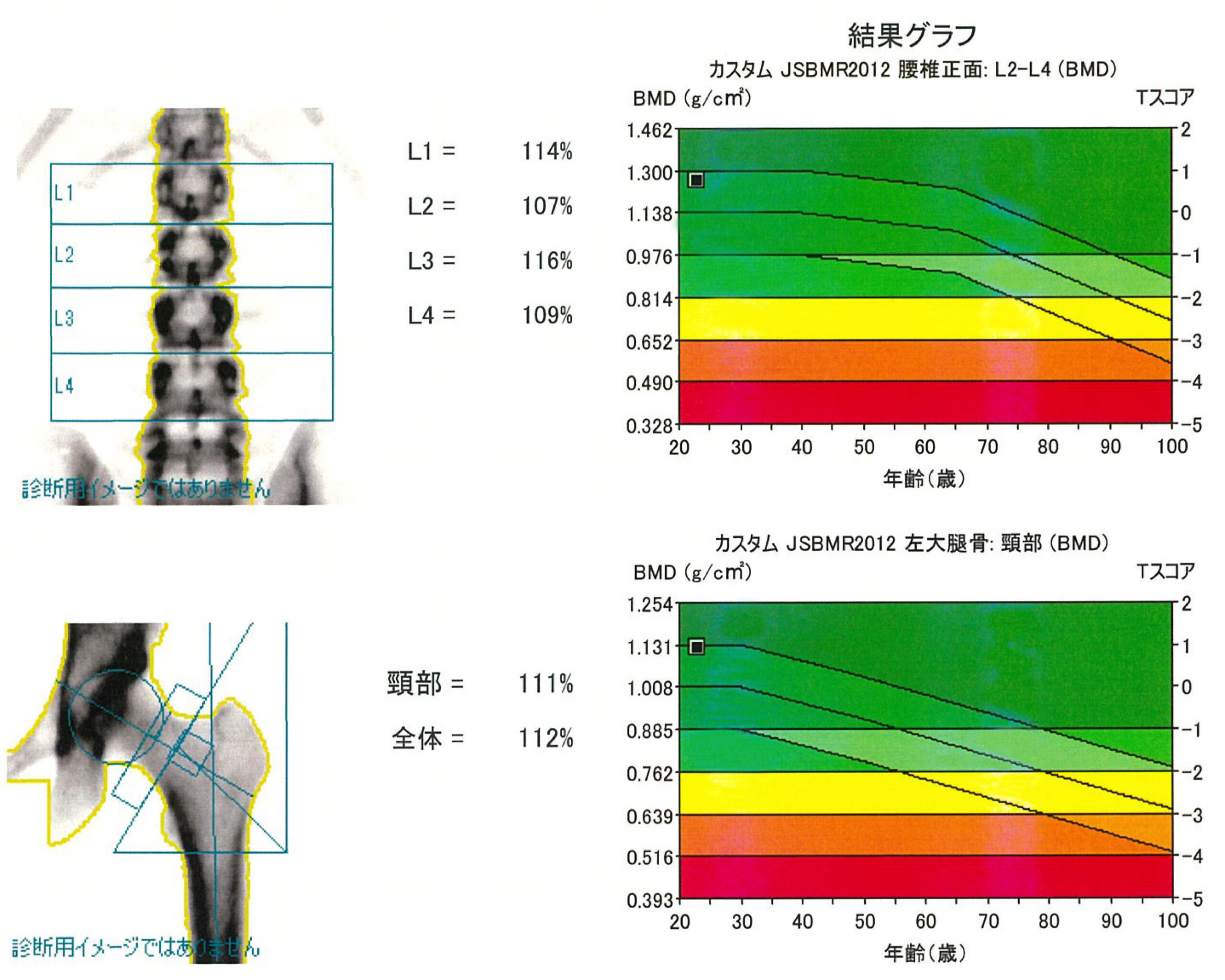 骨密度検査結果グラフ